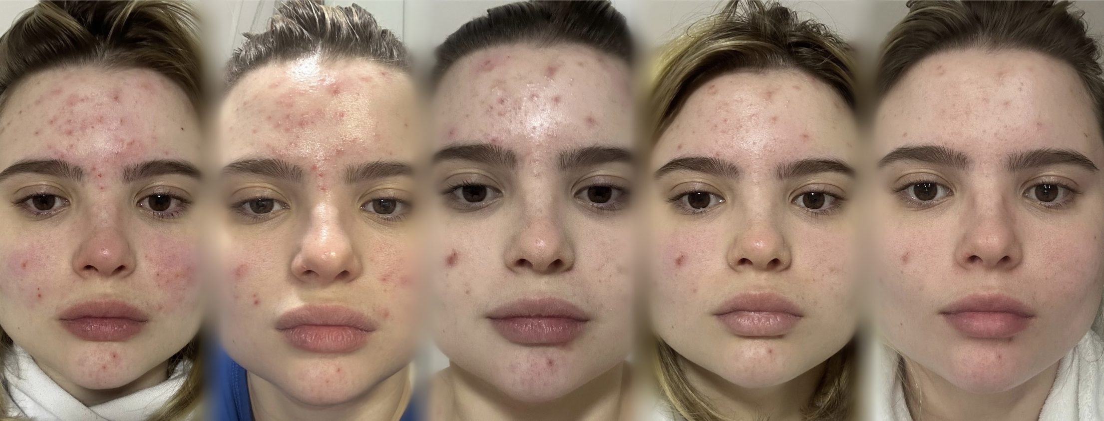 Cinco fotos do mesmo rosto ao longo de 7 dias de uso do Protocolo Calm: as espinhas inflamadas e a vermelhidão diminuem a cada dia